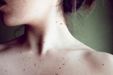 Вчені розповіли, як можна виявити рак шкіри